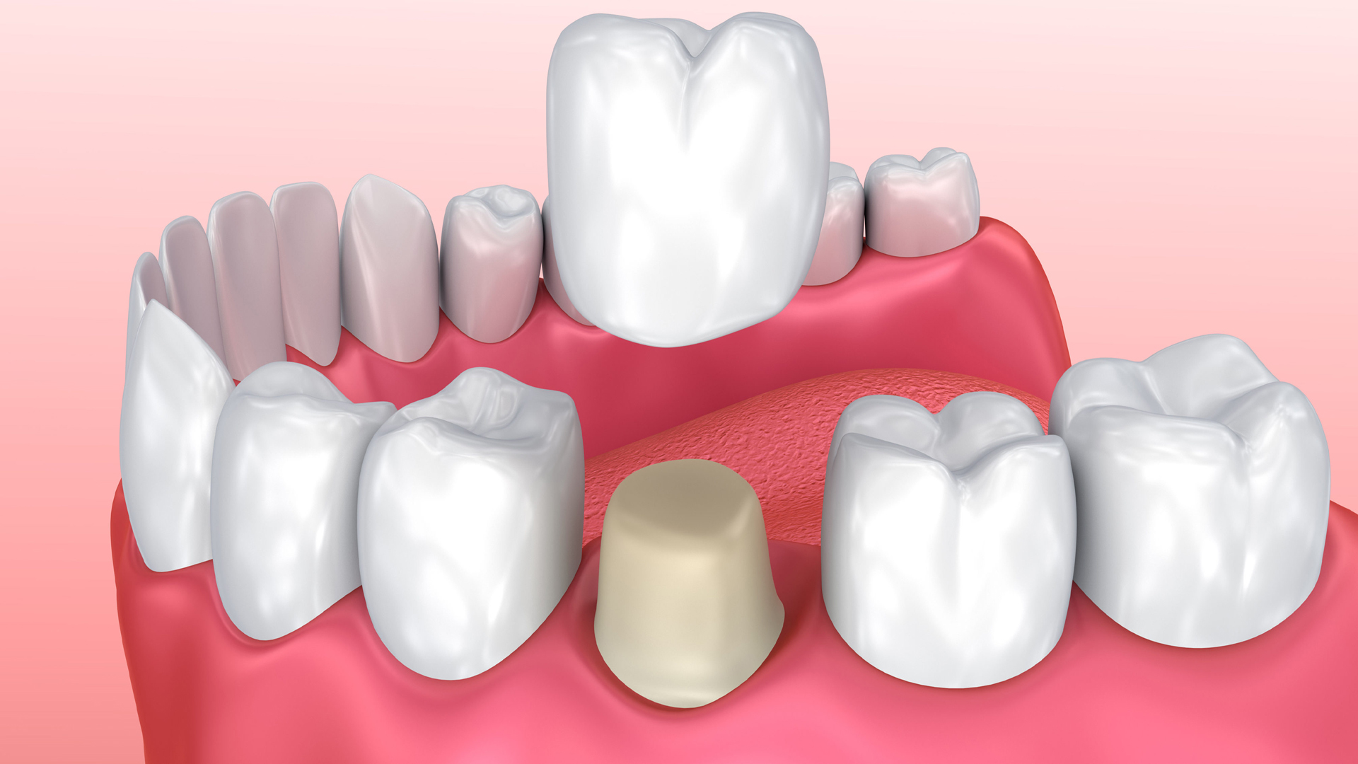 Dental Crown Promident Dental