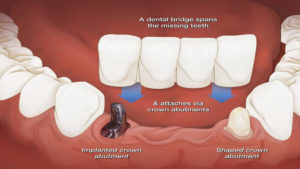 Dental Bridge | Banani | Promident Dental Clinic