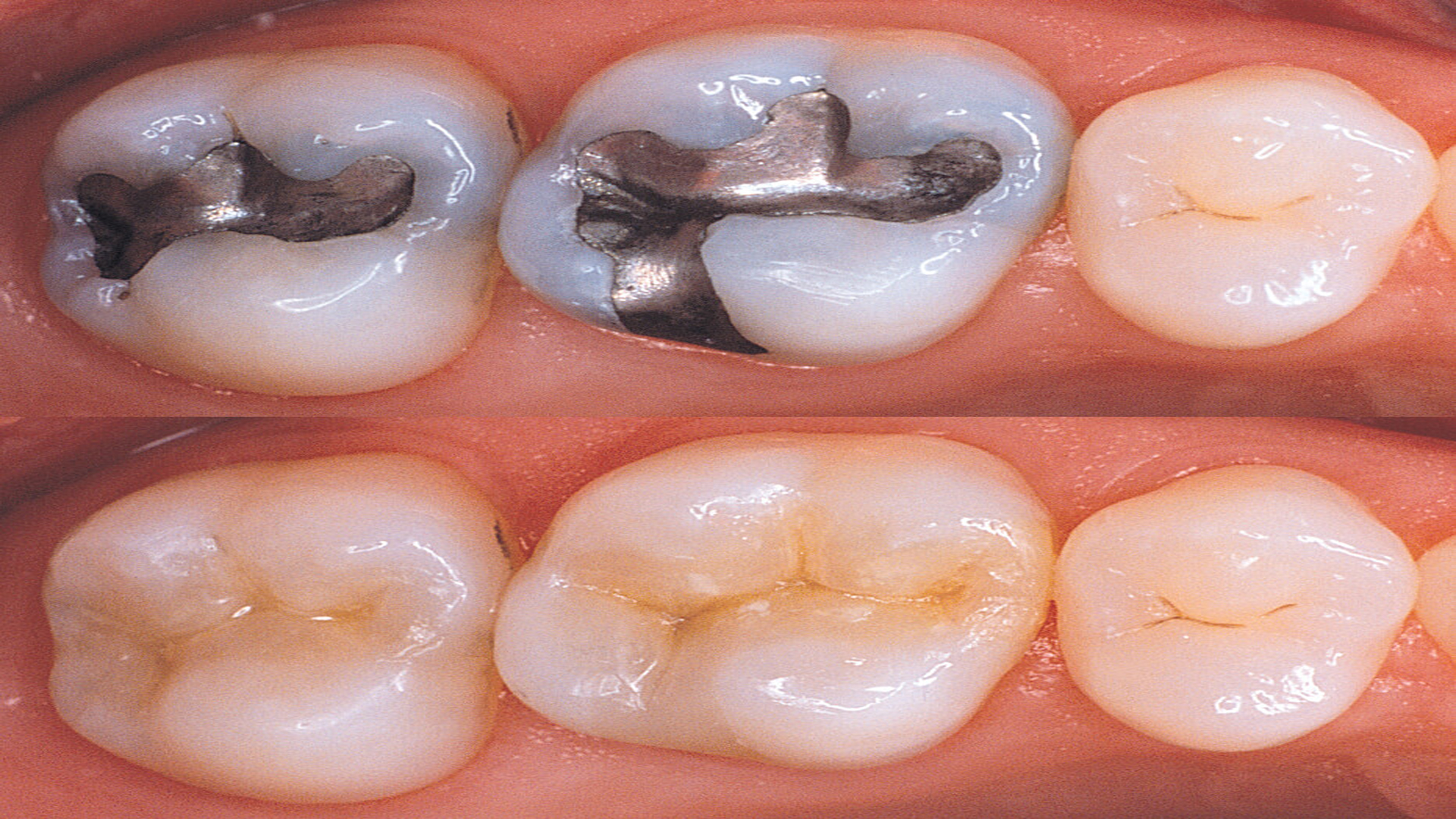 Cosmetic filling - Promident Dental